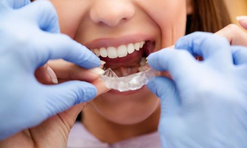 Clínica oferece tratamento inovador para alinhamento dentário em Mafra