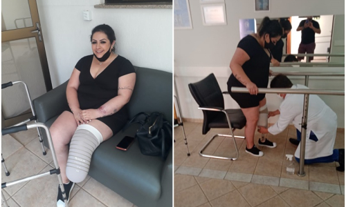Mafrense consegue prótese mecânica com vaquinha e volta a andar