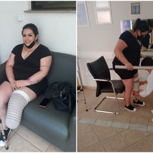 Mafrense consegue prótese mecânica com vaquinha e volta a andar