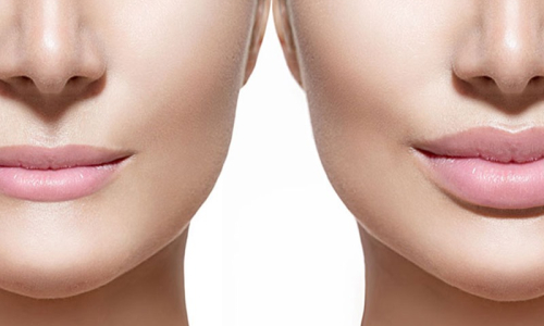 Preenchimento labial: entenda como funciona o procedimento