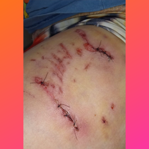 Como está o menino mordido por cachorro durante operação policial?
